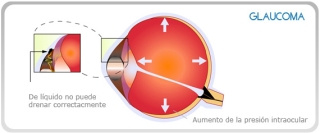 DETECCION GLAUCOMA EN VALENCIA